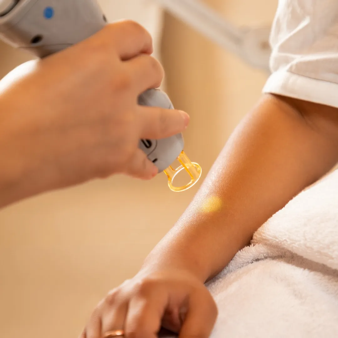 Diode Laser Hair Removal