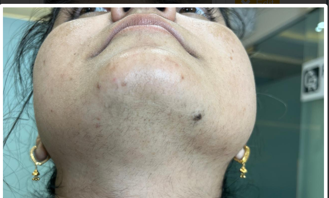 After Laser Hair Reduction