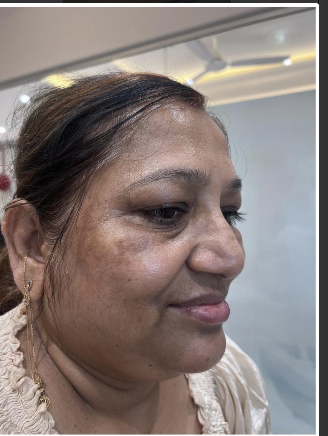 Before Pigmentation Treatment
