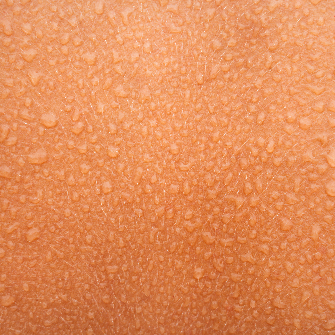 Hyperhidrosis Treatment