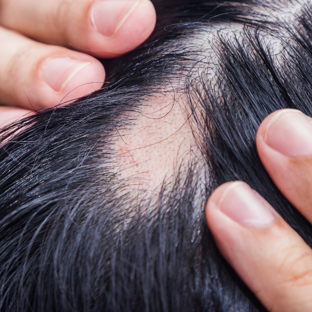 Alopecia Areata Treatment Process