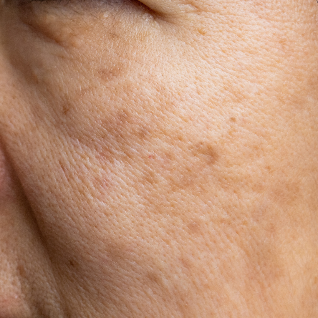 Melasma Treatment