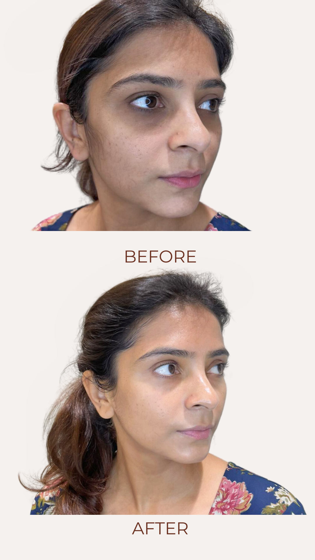 White-Minimal-Before-After-Treatment-Instagram-Story