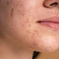 Clearer Skin Starts Here: Expert Acne Treatment in NIBM (Pune) | The Skin Firm