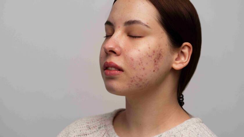 Acne Treatments in Pune