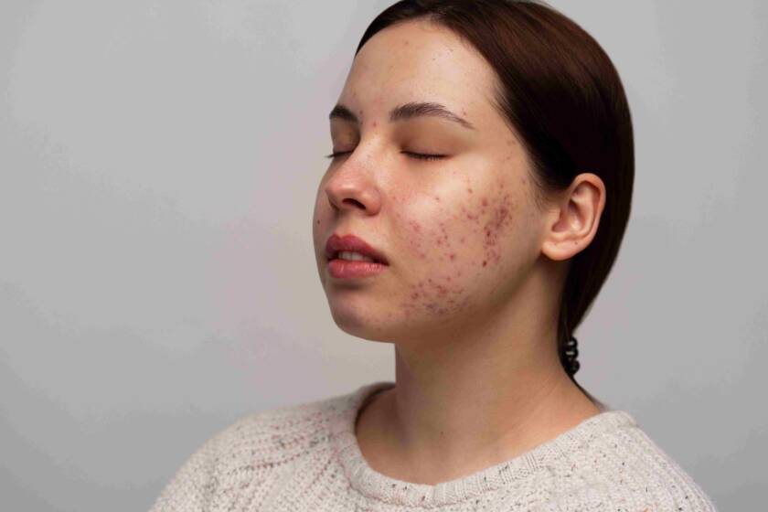 Acne Treatments in Pune