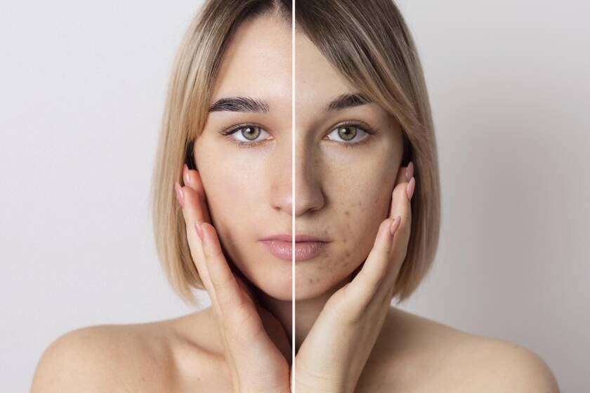 Hyperpigmentation